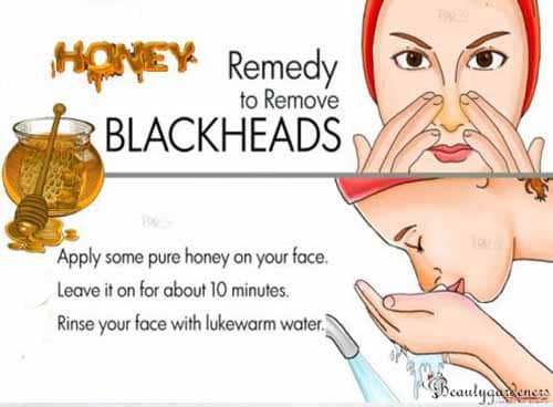 natural remedy for blackheads